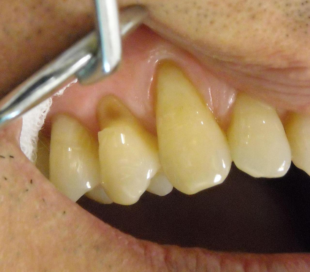 削 られ た 歯 再生