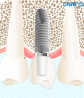 implant_image００４.gif