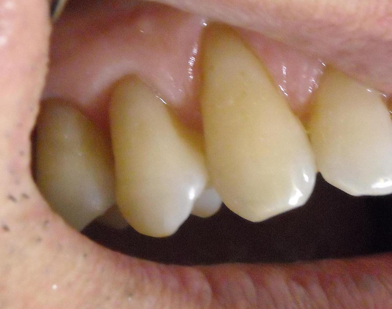 削 られ た 歯 再生